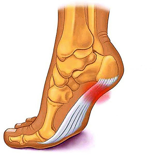 Potek plantarne aponevroze.