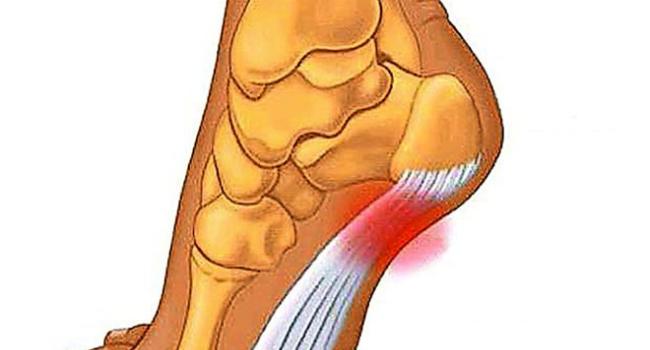 Potek plantarne aponevroze.